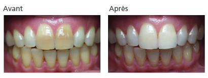 Eclaircissement dentaire à Reims